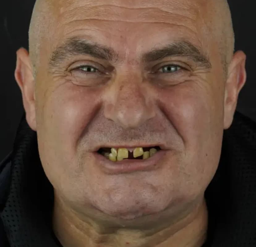Tedavi öncesi